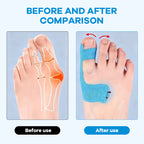 👠 Gå smertefritt i alle dine favorittsko: Den usynlige Hallux Valgus-tapen som retter opp tåen hele dagen! 🦶✨