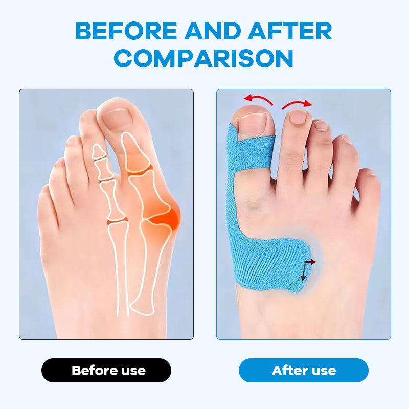 👠 Gå smertefritt i alle dine favorittsko: Den usynlige Hallux Valgus-tapen som retter opp tåen hele dagen! 🦶✨